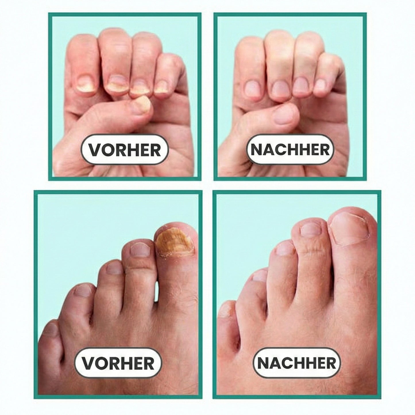 Noyra Care™ –  Laser-Gerät gegen Nagelpilz