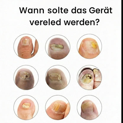 Noyra Care™ –  Laser-Gerät gegen Nagelpilz